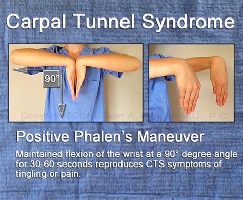 median nerve compression test cts|what is the phalen test.